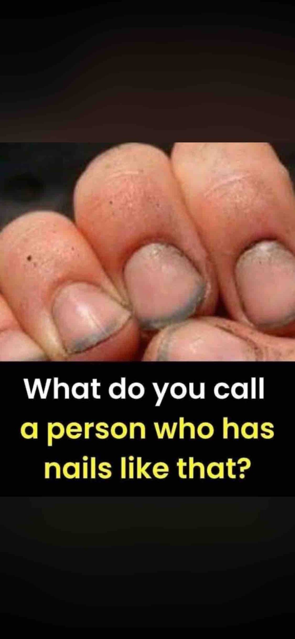 What do you call a person who has nails like that?